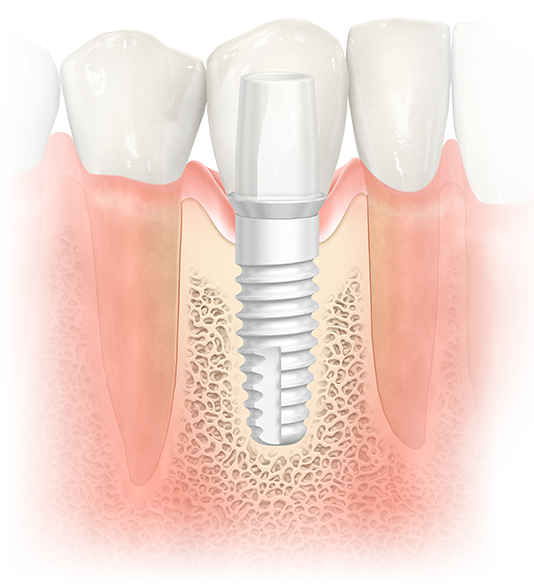 Muestra de implantes dentales de zirconio publicada por la clínica